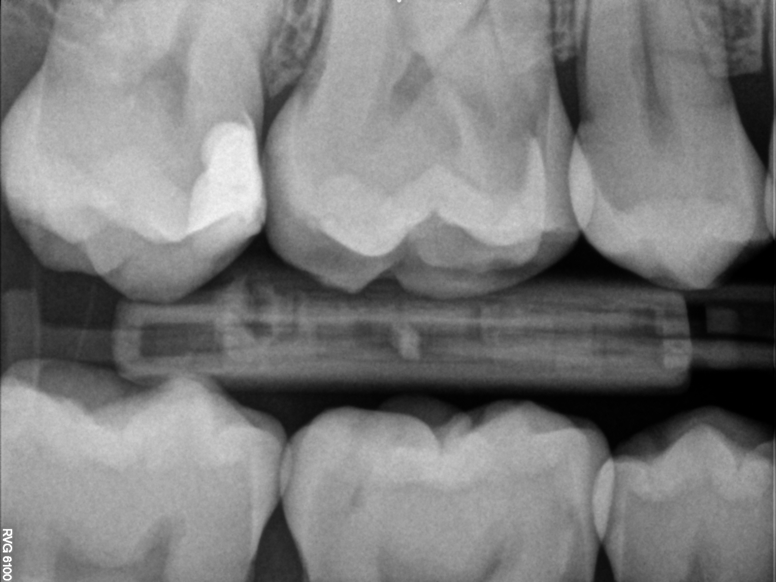 Behandlungsbedürftige Karies? | WURZELSPITZE